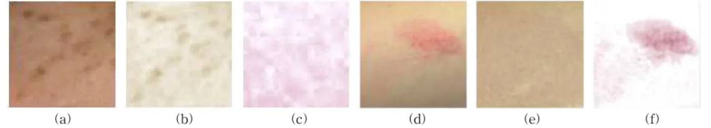 그림 8. (a) 흑점(black spot)을 가지는 피부에 대한 (b) 멜라닌과 (c) 헤모글로빈 성분, (d) 홍점(red spot)을 가지는 피부에 대한 (e) 멜라닌과 (f) 헤모글로빈 성분 (a) (b) (c) (d) 그림 9