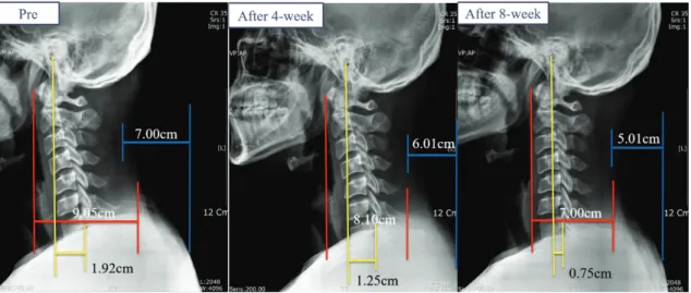Fig. 3. Lateral view of cervical spine pre, after 4- and 8-week therapeutic exercise in a patient A