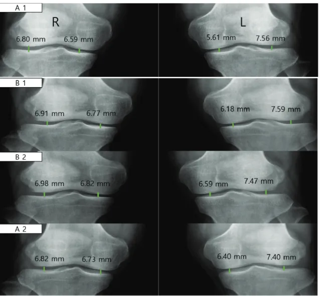Fig. 2. Changes in medial and lateral of knee joint space before (A 1), after 6- (B 1) and 12-week (B 2)  corrective exercise and 6-week of exercise completion (A 2).