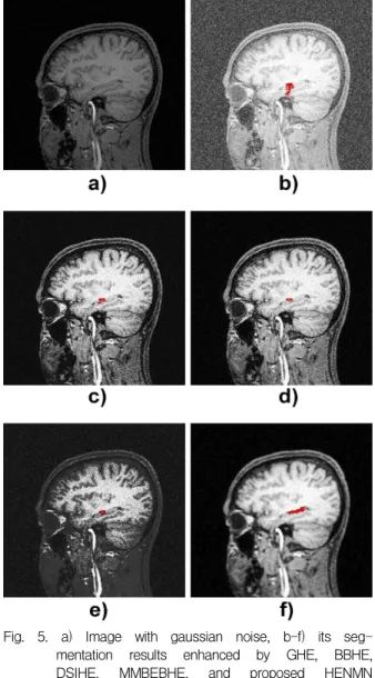 Fig. 5. a) Image with gaussian noise, b-f) its seg- seg-mentation results enhanced by GHE, BBHE, DSIHE, MMBEBHE, and proposed HENMN and filtered by gaussian filter sequentially.