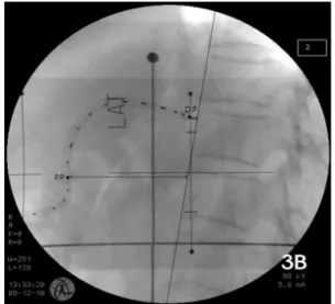 Figure  3.  Orthogonal  image  by  conventional  simulation  with  dummy  source  in  Intraluminal  brachytherapy 