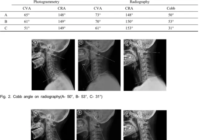 Fig.  2.  Cobb  angle  on  radiography(A-  50°,  B-  53°,  C-  31°)