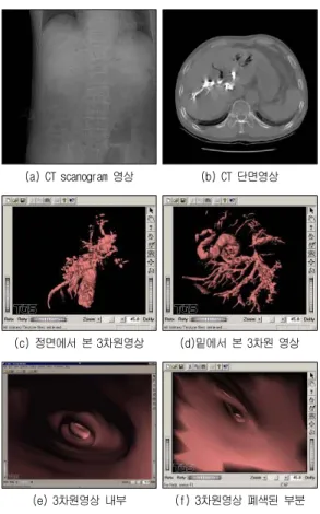그림 은 8 MRI 영상으로 (a) 는 DICOM 3.0 형식 의 관상단면 (cornal) 영상이며 , (b) 는 간담도계 차원3 영상으로 좌우측 간내담관과 총담관의 폐색으로 총담관과 담낭 (gall bladder) 이 확장되어 있고 , (c) 는 간내담관이 분기된 모습이고 총담관의 아래 부분 , 으로 폐색되어 있다 그림 는 