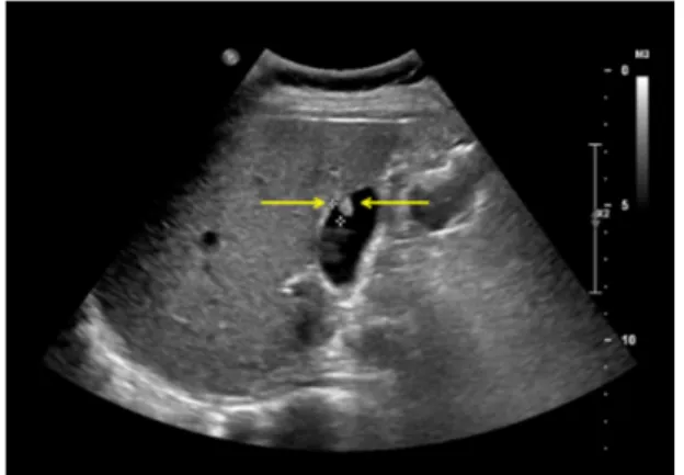 Fig.  1.  Ultrasound  imaging  of  the  gallbladder  polyp