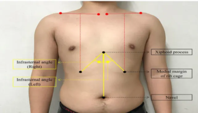 Fig.  1.  Measuremnt  of  infrasternal  angle 
