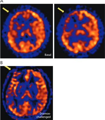 Figure 4.  The characteristic features of a hemodynamic study in Moyamoya  disease. (A) The single photon emission computed tomography and (B)  mag-netic resonance arterial spin labeling imaging shows marked decreases in both  the cerebrovascular reserve c