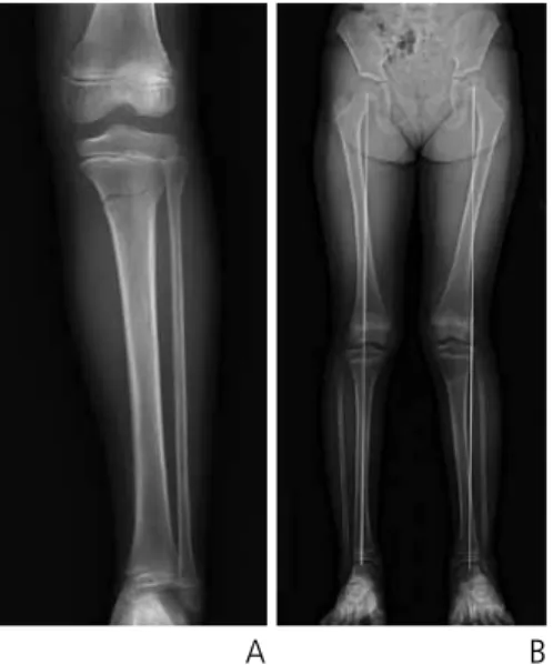 Figure 1.  Proximal tibia fracture of 8-years-old girl due to trampoline injury. (A)  Initial X-ray indicated typical trampoline fracture