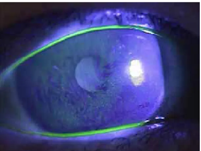 Figure 6.  Rose Bengal stain (×16) of conjunctiva in patient of dry eye syn-