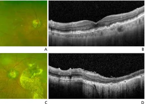 Figure 1.  Clinical finding of dry age-related macular degeneration. (A) Fundus photograph image of soft 