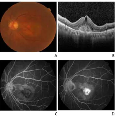 Figure 2.  Clinical findings of wet age-related macular degeneration. (A) Fundus photograph image of classic 