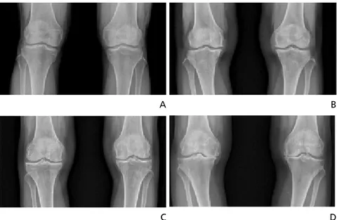 Figure 1.  Radiologic evaluation of knee osteoarthritis according to the Kellgren-Lawrence (KL) classification