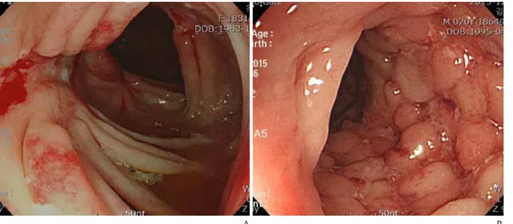 Figure 1.  Colonoscoic findings in Crohn disease. (A) Deep longitudinal ulcer and (B) cobble stone appearance.