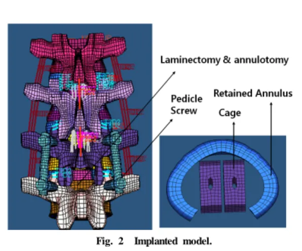 Fig. 2  Implanted model.