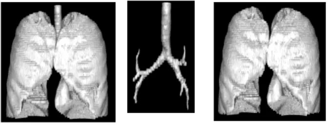 Fig.  12.  3D  image  of  Segmented  Airway  and  Lung