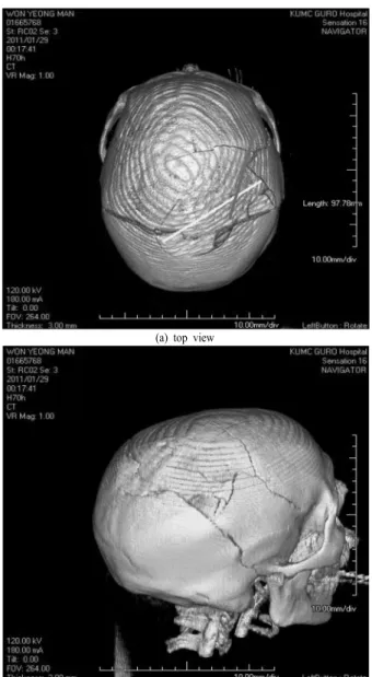 Fig. 1. The 3-dimension computed tomography of the damaged hu  man's skull.