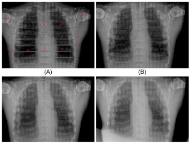 Fig.  3.  Representative  chest  AP  images  obtained  from  the  developed  PDR  according  to  different  angles:  (A)  0°,  (B)  10°,  (C)  20°  and  (D)  30°  angle  degree
