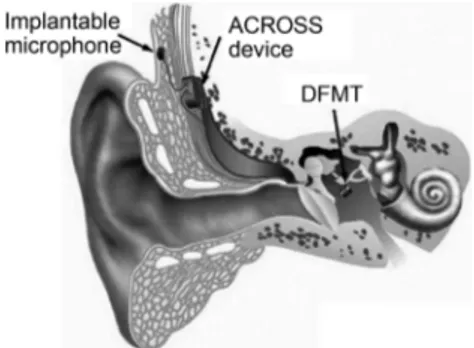 Fig. 1. Concept of ACROSS device placed under the temporal bone skin with DFMT attached on ossicular chain and an implantable microphone.