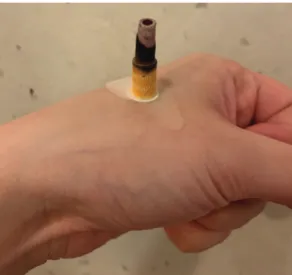 Fig. 2. Aplication of indirect moxibustion. The hand does not belong  to the patient in this study.