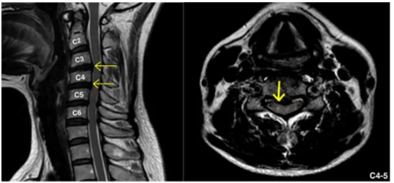 Fig. 1. C-spine MRI of Case 1.