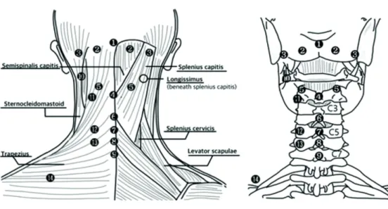Fig. 3. Acupotomy sites. ❶ Upper site of GV16 ❷ 2-2.5 cm side down of external occipital protuberance (GB20) ❸ 4.5-5 cm side down  of external occipital protuberance (GB12) ❹ Origin of trapezius muscle, insertion of nuchal ligament (GV16) ❺ Facet joint, si