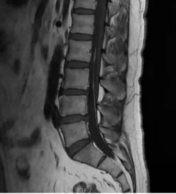 Fig. 1. T1 weighted sagittal plane central view of a lumbar MRI scan. The MRI scan  shows filum terminale lipoma extended from L2 to S1.