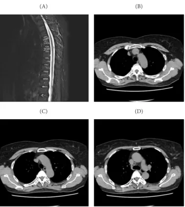 Fig. 2. T-spine MRI &amp; CT on 2020.03.03. (A) T-spine MR STIR, (B) T4 CT, (C) T5 CT,  (D) T6 CT.