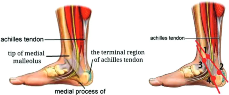 Fig. 1. Body surface localization of the operation point. Fig. 2. Acupotomy needle (Type1No 4.1.0*50mm).