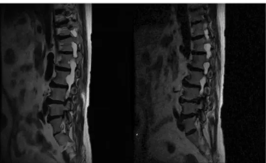 Fig. 2. T2 weighted sagittal plane of lumbar MRI at right and left foraminal view. The  scan shows both neural foraminal widening.