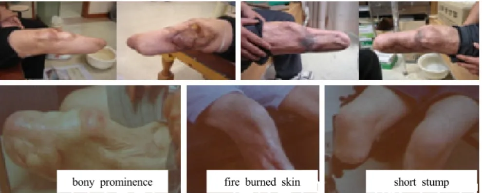 Figure 8. Apparatus for the long term durability test of silicone  liner (KSP 0235). 레이노병 (Raynaud's disease)에 의한 심혈관계 말초혈관 질환 과 당뇨병에 의한 합병증과 같은 후천적 질환에 의한 경우가  크게 증가하고 있다 