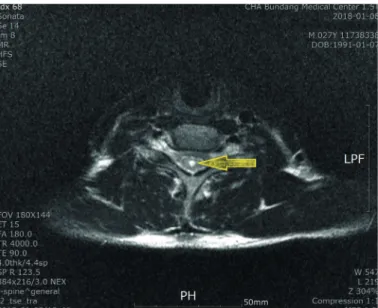 Fig. 2. T2 weighted transverse plane of magnetic resonance imaging at the level C5–6  (2018-01-08)