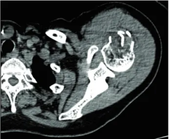 Fig. 2. Left shoulder computed tomography scan - coronal view (October 10, 2018).