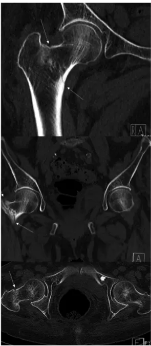 Fig. 1. Right pelvis CT (May 26, 2014).