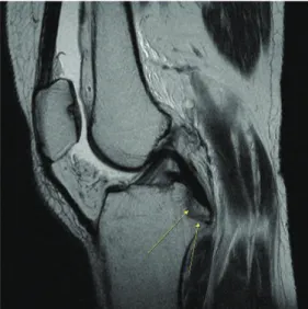 Fig. 1. Left knee MRI (January 20, 2018).