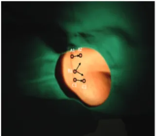 Fig. 1. Acupotomy site and direction.