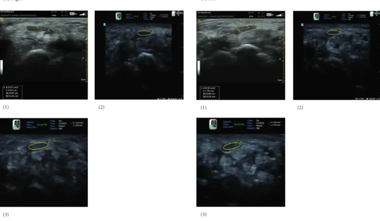 Fig. 4. Change of cross sectional area of median nerve from the Case 3 (A1), (B1) May  23, 2017, (A2), (B2) June 13, 2017, (A3), (B3) July 4, 2017.