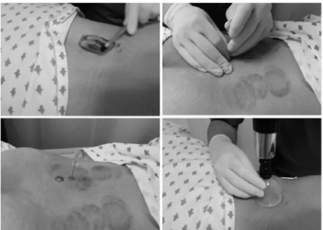 Fig. 1. Application of acupotomy on lumbar HIVD