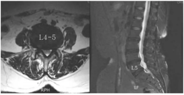 Fig. 4. L-spine MRI of case 3