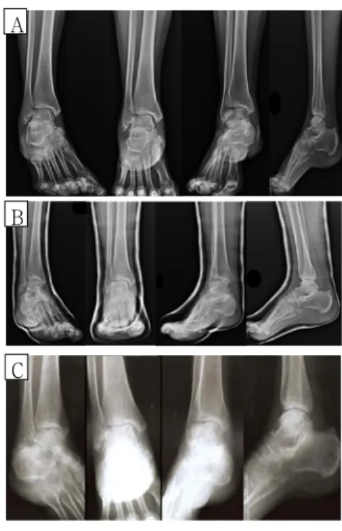 Fig. 1. Right ankle X-ray