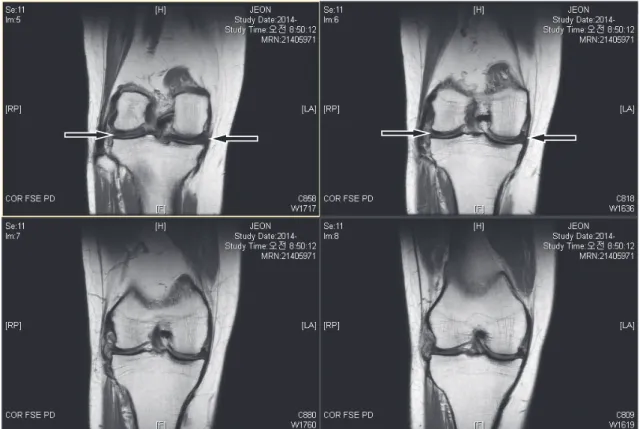 Fig. 1. Right knee MRI of case 1
