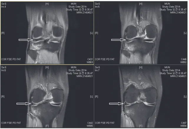 Fig. 2. Right knee MRI of case 2② 입원 기간 : 총 28일2) 주소증① 우하지통② 발병일 : 입원 6일 전③ 양상 : 찢어지는 듯한 통증, 가벼운 열감, 부종 없음, ROM 제한, 보행 장애3) 현병력상기 환자는 연관된 과거력이 없는 30세 남성으로, 입원 6일 전 작업 도중 담장에서 떨어지면서 우측 다리부터 착지하고 주저앉은 뒤로 우측 슬통이 시작되어 local 정형외과에서 XR 등의 촬영으로 특별한 이상은 없으나 입원치료가 