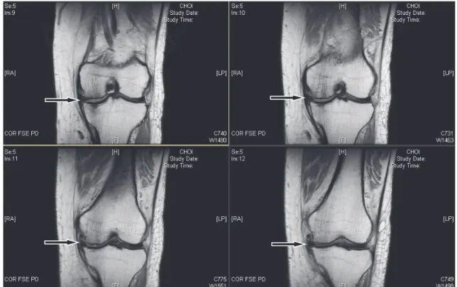 Fig. 4. Left knee MRI of case 4 5) 한의학적 검진 ①  설 질담백 치흔 태후황, 맥 침활 ②  체형 : 키 149 cm / 몸무게 74 kg ③  간헐적 단기 증상 외 소화, 배뇨배변, 수면, 순환, 생 식 등 전체적인 인체 생리 기전에 대해 별무 증후 및  증상 6) 서양의학적 검사 소견