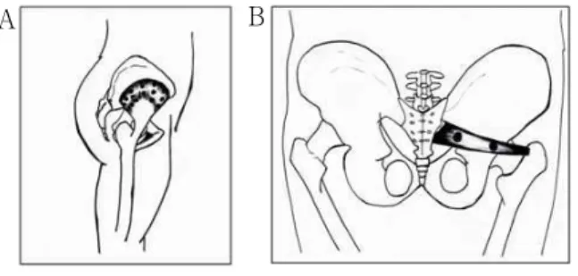 Fig. 1. Trigger points in gluteus minimus  muscle(A) and piriformis muscle(B)