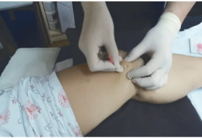 Fig. 1. Application of needle-embbeding therapy on knee painⅠ. 서  론퇴행성 관절염은 성인에서 가장 흔한 관절 질환으로 관절 연골이 닳아 없어지면서 국소적인 퇴행성 변화를 보이며, 연골하골의 비대, 주변 골연골부의 과잉 골형성, 관절의 변형 등이 특징적으로 나타나는데, 주로 체중부하 관절을 많이 침범하므로 보행 시 부하를 많이 받는 슬관절에서 집중적으로 나타난다1)