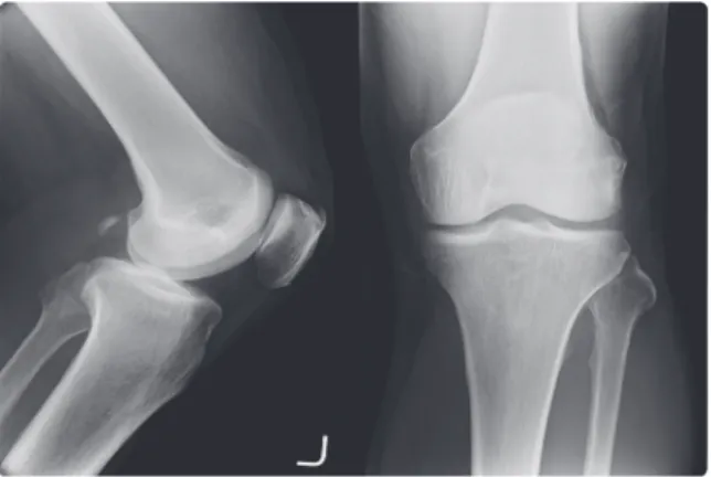 Table 3. Change of NMR and WOMAC Index of Case 3Fig. 4. Lt knee Ap/Lat X-ray of case 32014년 7월 7일 매선 2회 치료 후 NRS는 5로 감소하였고, WOMAC index는 50점으로 줄었으며, 화끈거리는 통증은 다소 줄어들었으나 계단을 내려가는 동작은 여전히 힘들고 다만 평지를 10분 이상 걸을 때 발생하는 통증이 약간 경감하였다고 하였다.2014년 7월 12일 매선 3회 치료 후 