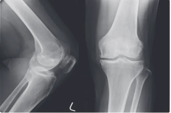 Table 4. Change of NMR and WOMAC Index of Case 4Fig. 5. Lt knee Ap/Lat X-ray of case 4