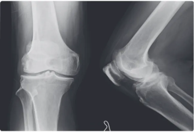 Table 5. Change of NMR and WOMAC Index of Case 5Fig. 6. Rt knee Ap/Lat X-ray of case 5