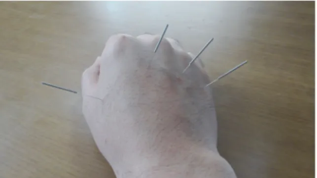 Fig. 1. Example of A-shi point acupuncture on  hand edema