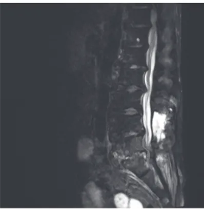 Fig. 1. Pre-Op state  L-spine MRI(2013. 12. 7)    