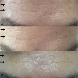 Fig.  4.  Patient  4  :　 59  years  old  female(wrinkle  between the eyebrows)