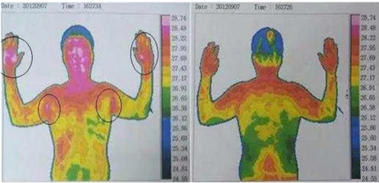 Fig. 3. Digital infrared thermal imaging(DITI) 2012. 09. 07 Left  shoulder  28  ℃,  right  shoulder  28.4  ℃.